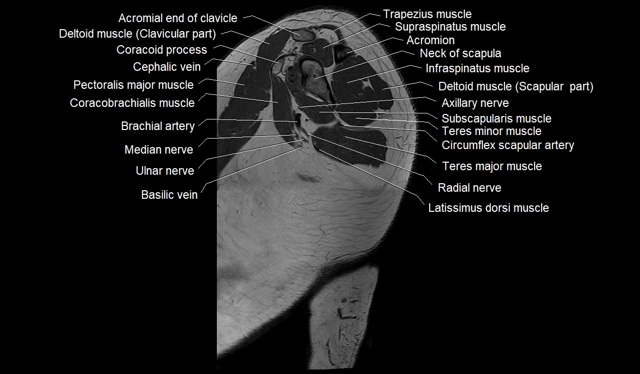 Upper arm (humerus ) saittal cross sectional anatomy 3T image 29.webp